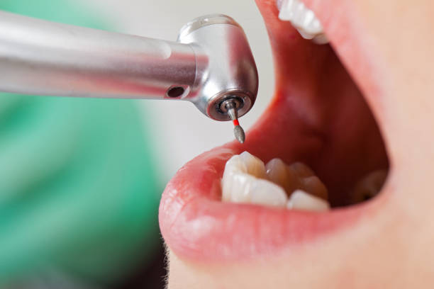 Best Emergency Tooth Extraction in Hilltop, MN